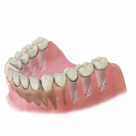 Brak kilku zębów – odbudowa na implantach - Stomatologia Perfektdent Białołęka i Tarchomin