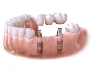 Brak kilku zębów – most na implantach - Stomatologia Perfektdent Białołęka i Tarchomin