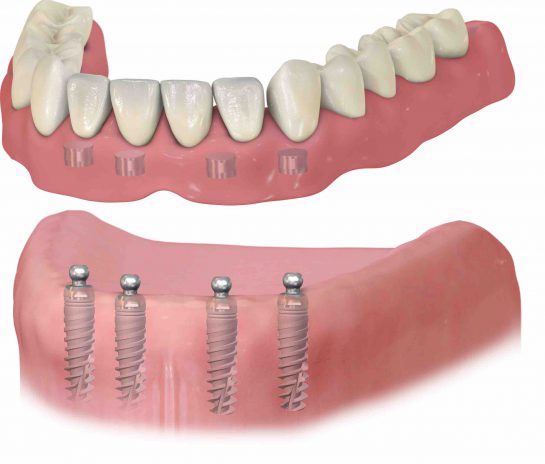 Brak kilku zębów lub całkowity brak zębów - Stomatologia Perfektdent Białołęka i Tarchomin