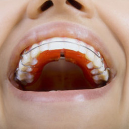 Komu ortodonta zaproponuje aparat ruchomy? - Stomatologia Perfektdent Białołęka i Tarchomin